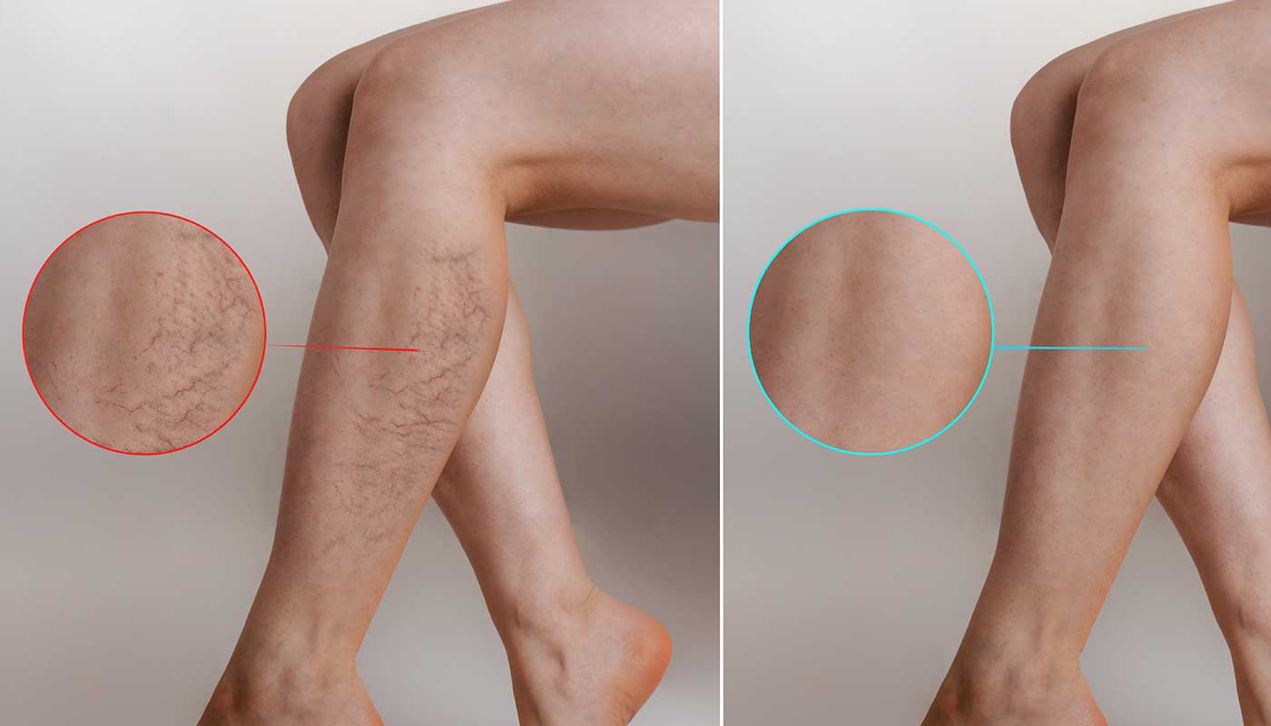 spider-veins-before-after-miami-vein-center spider-veins-before-after-miami-vein-center